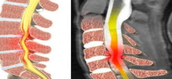 Estenosis Espinal O Canal Lumbar Estrecho Clínica Bienestar Para Tu Columna 8914